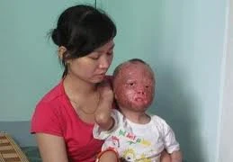 Thảm thương cháu bé bị cha tẩm xăng đốt 