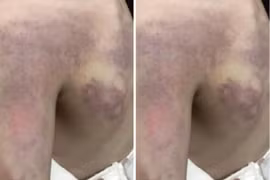 Đình chỉ cô giáo đánh bầm tím vai, lưng học sinh lớp 3