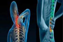 Điều trị thoát vị đĩa đệm cột sống như thế nào