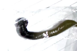 Đỉa sống trong thanh quản cháu bé 11 tuổi