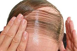 Trị liệu mới cho bệnh hói đầu và bạc tóc