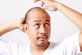 Hói đầu làm tăng nguy cơ bệnh thần kinh nghiêm trọng