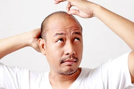 Hói đầu làm tăng nguy cơ bệnh thần kinh nghiêm trọng