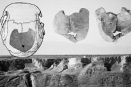 Lỗ thủng ở hộp sọ: Dấu hiệu hôn nhân cận huyết thống