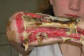 Khủng khiếp ma túy tự chế “cá sấu”: Rẻ, "phê" nhưng cực độc