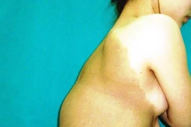 Cắt bỏ khối u nặng 7kg trên lưng nữ bệnh nhân