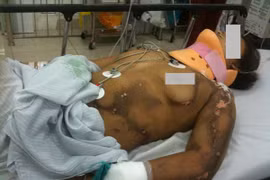 Hà Nội: Đang cấy lúa, một phụ nữ bị sét đánh bất tỉnh