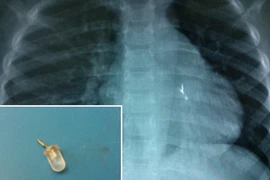 Phát hoảng với những ca "nuốt" bóng đèn của trẻ em