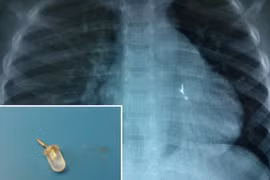 Phát hoảng với những ca "nuốt" bóng đèn của trẻ em