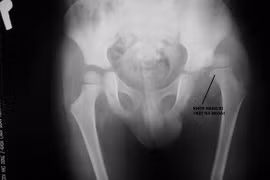 Bé 4 tuổi nhảy lên giường, ngã trật khớp háng