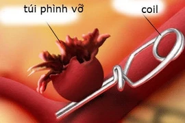 Cứu sống bé 11 tuổi bị vỡ túi phình mạch máu não 