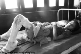 Bị nhà chồng thiêu sống vì không nộp đủ của hồi môn