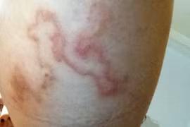 Đi đắp bùn làm đẹp bị nhiễm giun móc chó