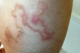 Đi đắp bùn làm đẹp bị nhiễm giun móc chó