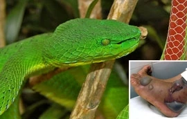 Bị rắn lục rắn, bé 9 tuổi bị rối loạn đông máu toàn thân