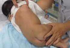 Bé 1 tháng tuổi bị ngộ độc vì dùng thuốc lào để tẩy lông