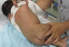 Bé 1 tháng tuổi bị ngộ độc vì dùng thuốc lào để tẩy lông