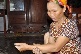 Xanh mặt chuyện một phụ nữ “đẻ” ra đỉa dài 30cm, to bằng cổ tay