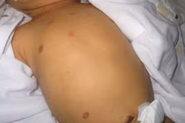 Bé sơ sinh nguy kịch do cắt dây rốn bằng kéo sinh hoạt