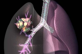 Vaccin điều trị ung thư phổi đầu tiên trên thế giới