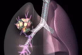 Vaccin điều trị ung thư phổi đầu tiên trên thế giới