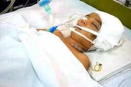 Chấn thương sọ não ở trẻ nhỏ - Hiểm họa khôn lường