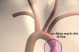 Bé sơ sinh suýt chết vì suy tim nặng