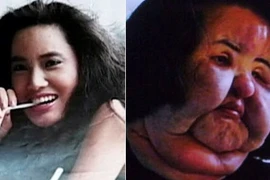 Những thảm họa kinh hoàng từ phẫu thuật thẩm mỹ