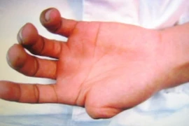 Giận vợ, tự mình chặt đứt bàn tay rồi đem luộc