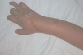 Một phụ nữ bị chém đứt gân tay vì chưa trả hết tiền nợ