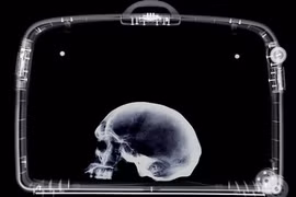 Bị bắt vì mang sọ người trong vali