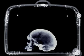 Bị bắt vì mang sọ người trong vali