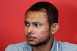 Rợn người gương mặt đầy sẹo của tuyển thủ Malaysia bị tạt axit