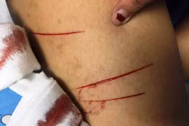 Nữ sinh bị kẻ biến thái sàm sỡ rồi rạch đùi khi đi một mình