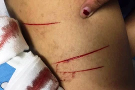 Nữ sinh bị kẻ biến thái sàm sỡ rồi rạch đùi khi đi một mình