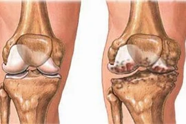 Viêm khớp gối đang tấn công lứa tuổi trẻ hơn
