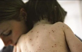 Ánh sáng mặt trời ngăn chặn bệnh thủy đậu lây lan