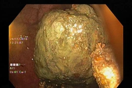 Kỳ lạ nữ bệnh nhân có 4 khối bã thức ăn to như quả trứng trong dạ dày