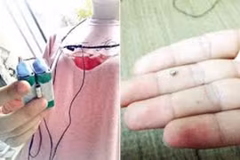 Thi THPT quốc gia: "Tuyệt chiêu" gian lận sử dụng tai nghe siêu nhỏ bằng hạt đậu