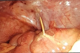 Hà Nội: Người đàn ông bị thủng ruột do vô tình nuốt que tăm