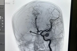 Cứu sống nam thanh niên bị thanh sắt cắm sâu vào mắt do tai nạn xe máy