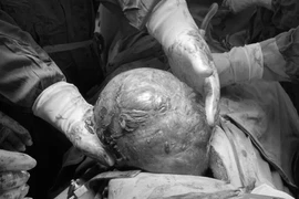 Cứu sống bệnh nhân có khối u khủng đè xẹp phổi, choán gần hết lồng ngực