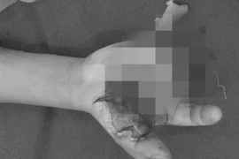 Liên tiếp 4 thanh thiếu niên nhập viện do dùng pháo tự chế