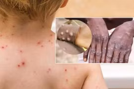 Bộ Y tế họp khẩn cùng WHO: Việt Nam chưa có ca bệnh đậu mùa khỉ nhưng nguy cơ rất lớn