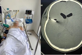 Cứu sống người đàn ông bị súng bắn đinh bắn thủng sọ não