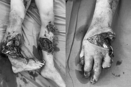 Người đàn ông 48 tuổi phải cắt cụt chi do nổ bình ga khi đang nấu ăn