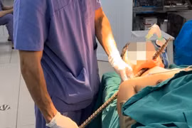 Người đàn ông được đưa vào viện với thanh xà beng dài gần 1m đâm xuyên vùng cổ