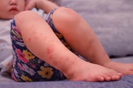 Số trẻ mắc tay chân miệng ở Hà Nội bất ngờ tăng mạnh, một ổ dịch mới ở Hà Đông