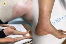 Bẻ nhãn trong sân cơ quan, nữ nhân viên văn phòng ở Hà Nội bị ong đốt nhập viện