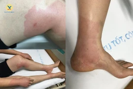 Bẻ nhãn trong sân cơ quan, nữ nhân viên văn phòng ở Hà Nội bị ong đốt nhập viện